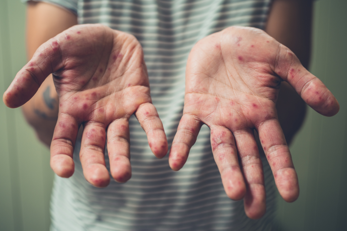 Philippines Reports Increase in Hand, Foot, and Mouth Disease Cases